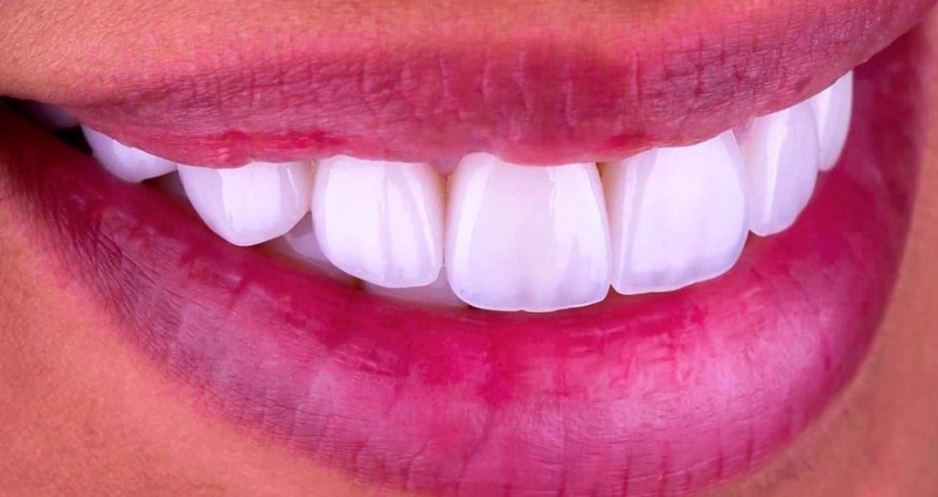 red lips white white veneers