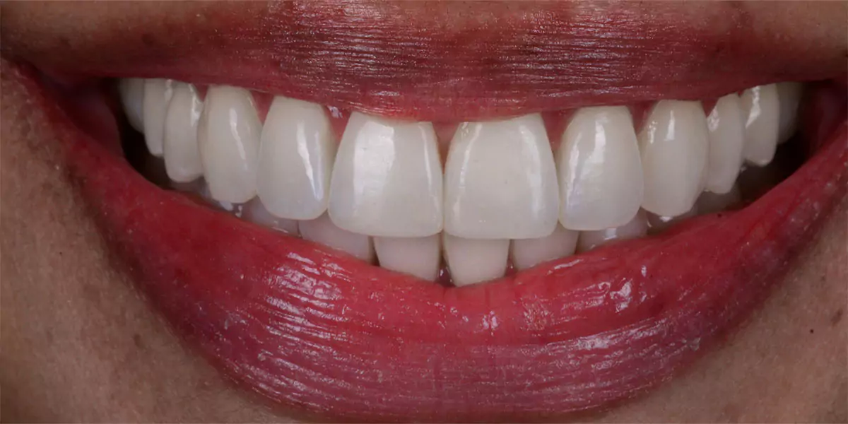 Blanchiment Dentaire Au Fauteuil Chez D1 Dental Concept Mont-sur-Lausanne