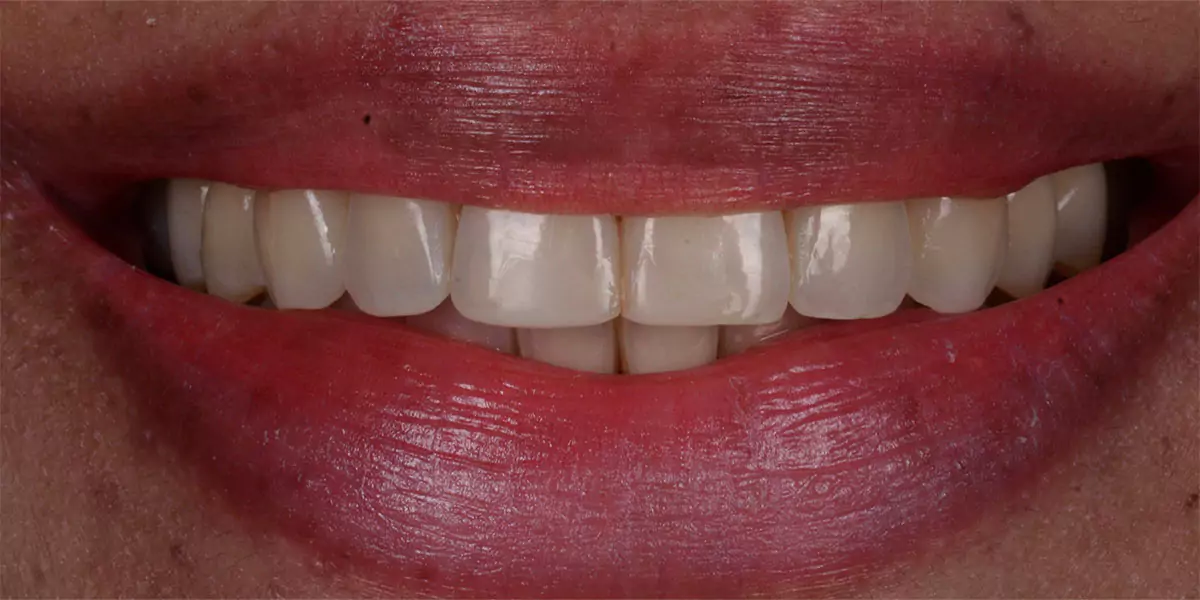 Blanchiment Dentaire Au Fauteil Chez D1 Dental Concept Mont-sur-Lausanne