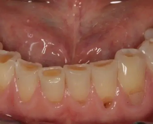 erosion dentaire Mont-sur-Lausanne