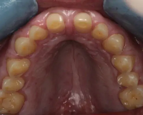 erosion dentaire Mont-sur-Lausanne