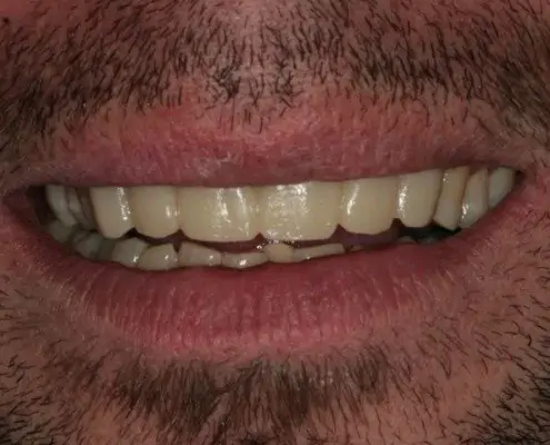 erosion dentaire Mont-sur-Lausanne